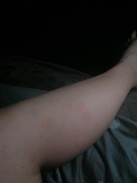 Červené modřiny na nohou. Jaké jsou vaše zkušenosti?