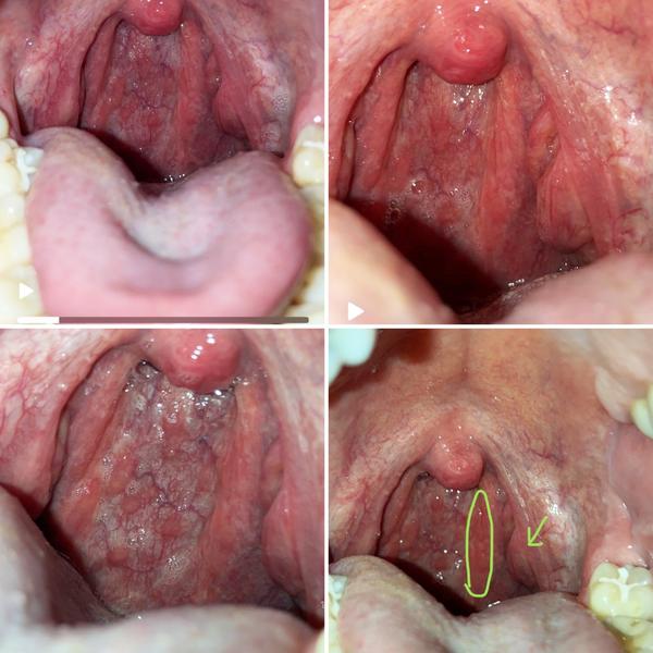 Zarudlý krk a zvětšená mandle. Jak to řešit?