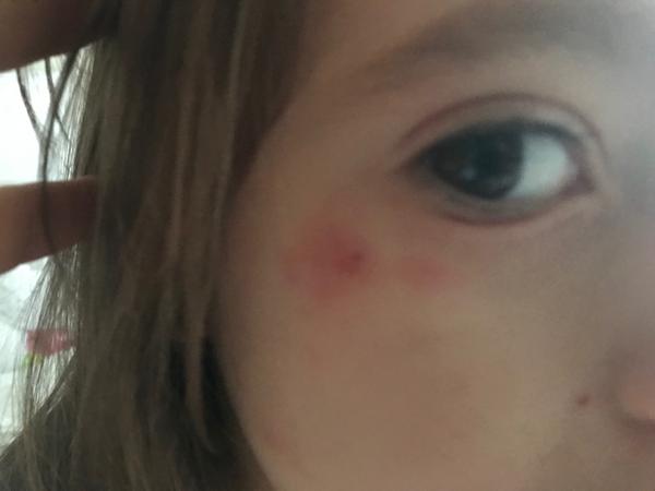 Ekzém, dcerka 3,5 roku. Je kvasinkový?