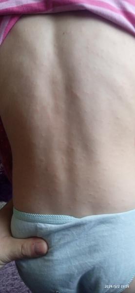 Vyrážka. Co by to mohlo být?