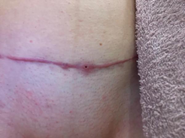 Díra v jizvě tři měsíce po císaři. Co dělat?