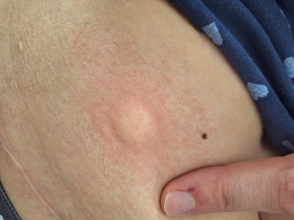 Velké kulaté kousnutí hmyzem: Jak zjistit původ?