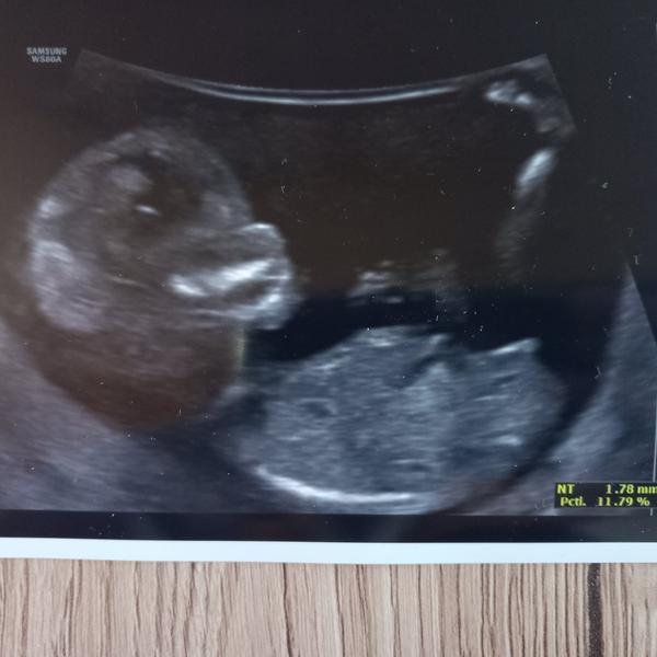 Může někdo určit pohlaví podle ultrazvuku ve 13+3 týdnu?