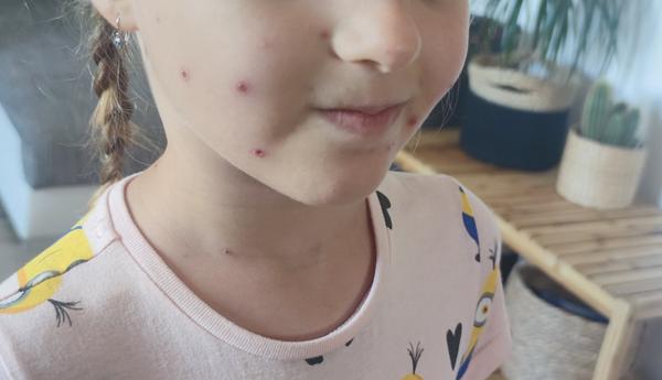 Pupínky u dcery po návštěvě moře: neštovice nebo alergie?