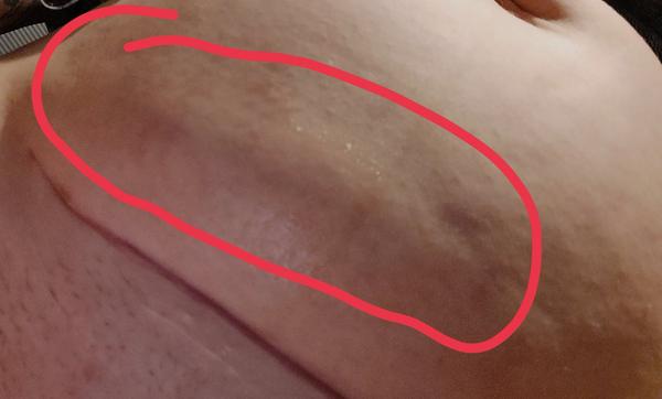 Opuch po císařském řezu. Máte podobnou zkušenost?