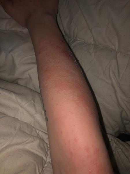 Problém na kůži, nejspíš ekzém, který velmi pálí. Mohla byste mi prosím pomoci?