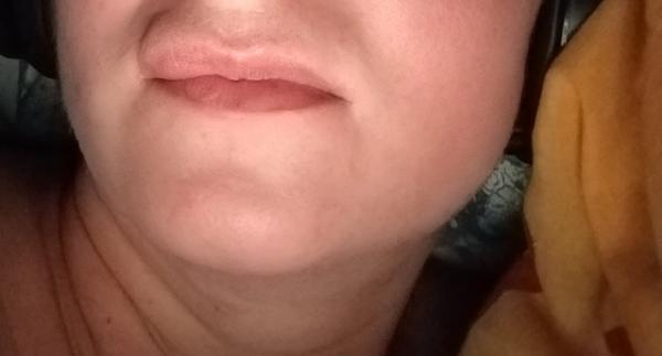 Jak řešit svědivou vyrážku na začátku těhotenství?