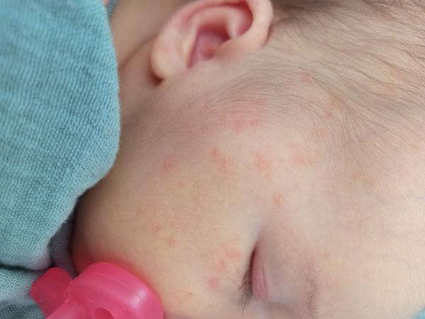 Vyrážka u miminka. Co s tím?