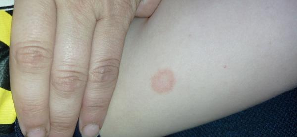 Atopický ekzém nebo plíseň na noze dítěte?