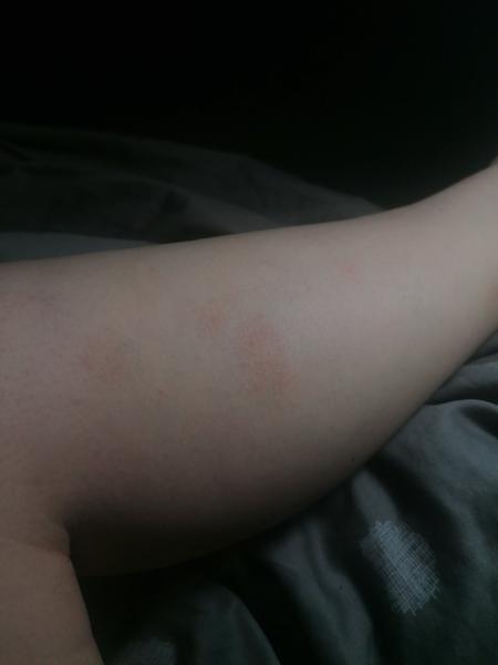 Červené modřiny na nohou. Jaké jsou vaše zkušenosti?