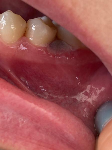 Modřina na dásni? Čím podpořit hojení?