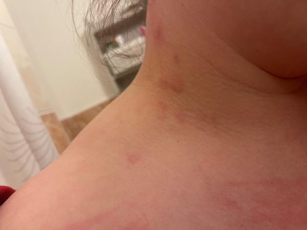 Alergie nebo kopřivka?