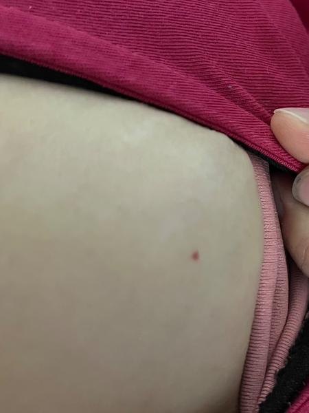 Červené tečky na kůži. Jsou to petechie nebo hemangiom?