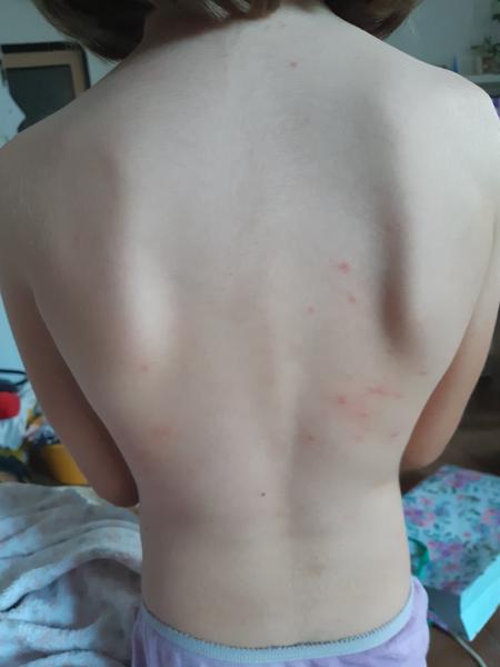 Jak rozpoznat neštovice a kdy navštívit lékaře?