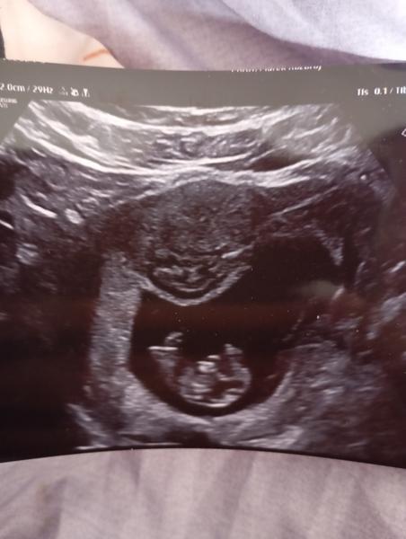 Je myom během těhotenství nebezpečný pro matku i dítě?