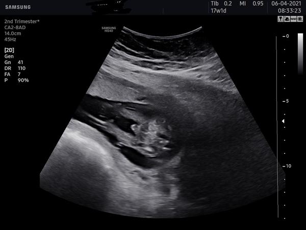 Pohlaví miminka. Co říkáte?