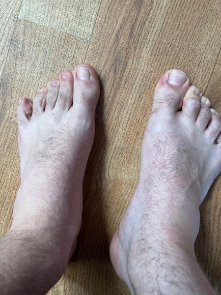 Jak odhalit plochou nohu a mohu ji léčit?