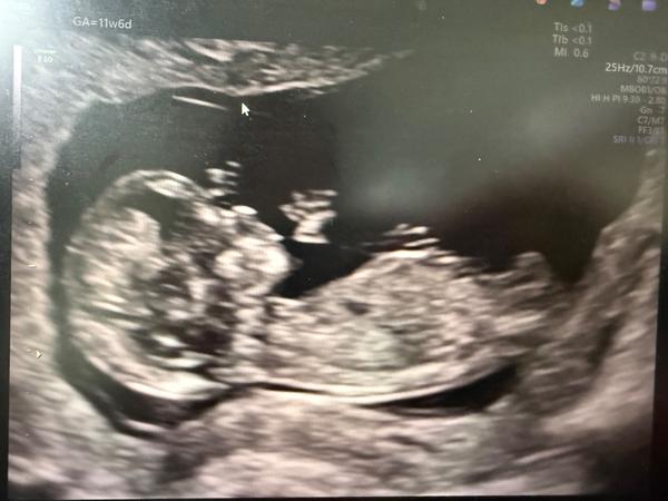 Pohlaví podle screeningu ve 12. týdnu. Co myslíte?