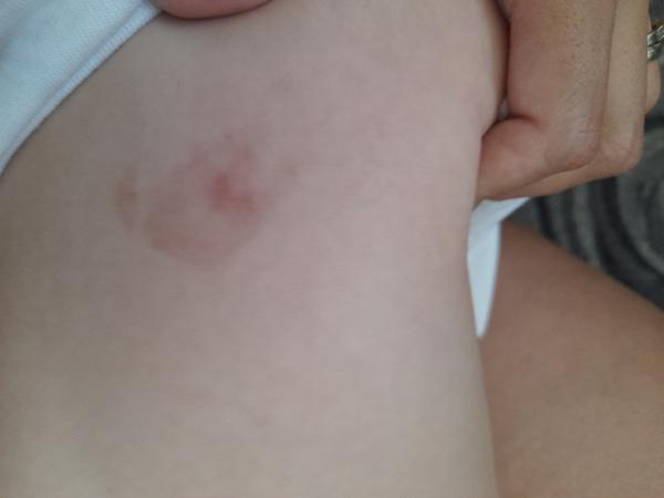 Flek na zádech u dítěte. Je to pigmentová skvrna?