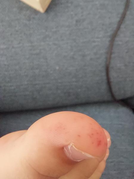 Tečky na palečcích dcery. Je to pocení nebo plíseň?