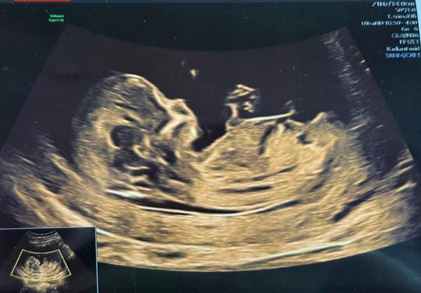 Jak určit pohlaví podle pohlavního hrbolku?