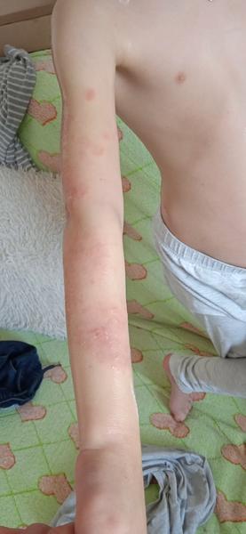 Ekzém nebo kvasinka?