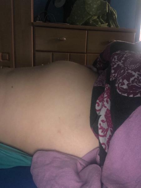 Divný tvar těhotenského bříška - hrbolek