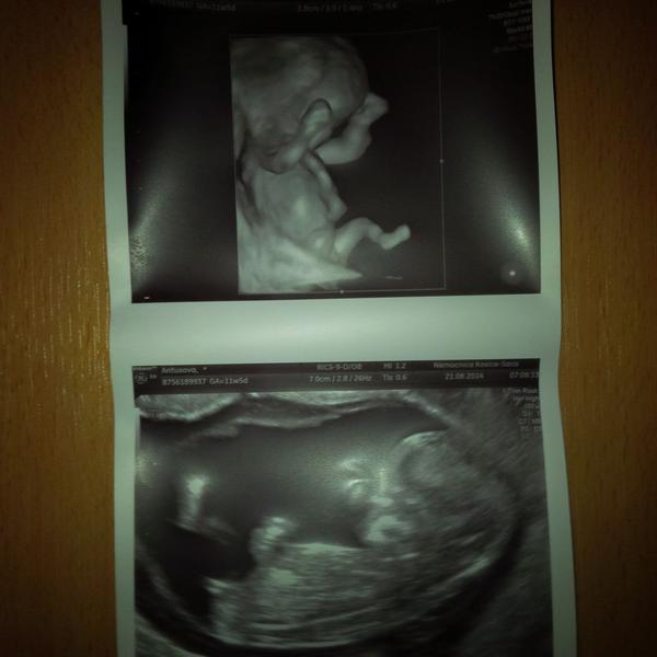 Myslíte, že to bude chlapec alebo dievča? 🙂 