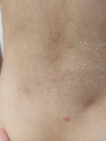 Léčba neštovic u dětí: Který gel použít?