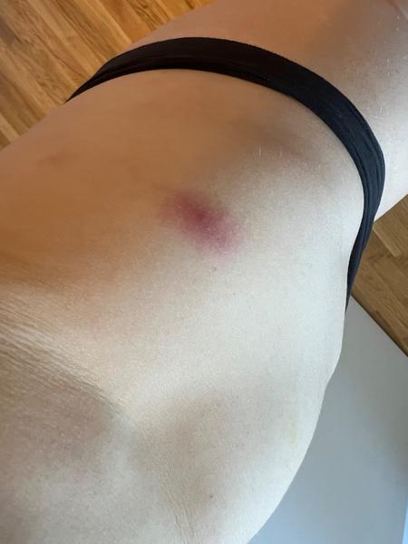 Mohou být pupínky příznakem neštovic během těhotenství?