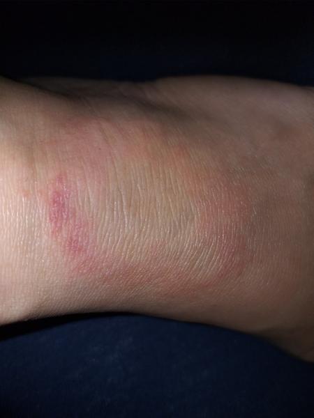 Červený flek na nártu. Borelióza, mykóza nebo něco jiného?