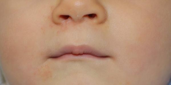 Ekzém ci periorální dermatida