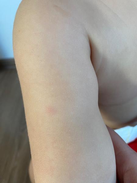 Co způsobuje bolestivé červené pupínky po prodělaném covidu?