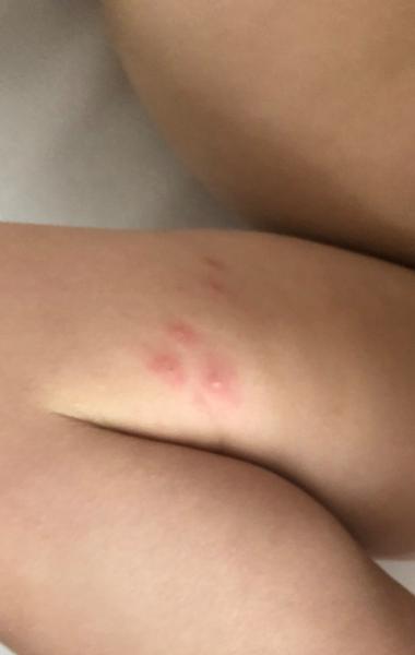 Neštovice nebo jen komáří štípnutí na stehnech?