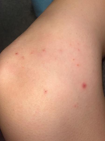 Vyrážka. O co by se mohlo jednat?