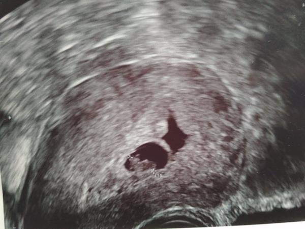 Částečné odloučení plodového vejce. Máte zkušenost?