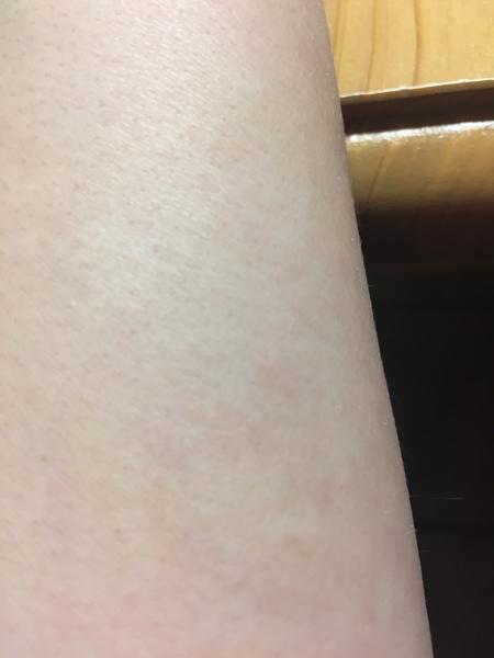 Fleky po celém těle. Co by to mohlo být?