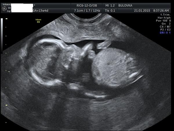 Chlapeček nebo holčička?