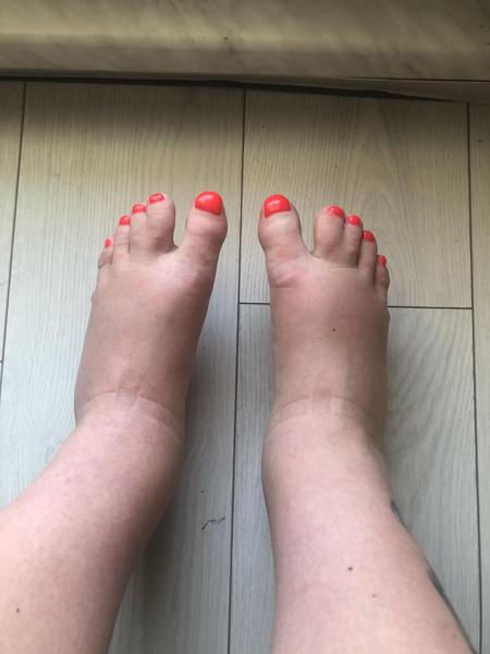 Jak řešit otoky nohou ve 24. týdnu těhotenství?