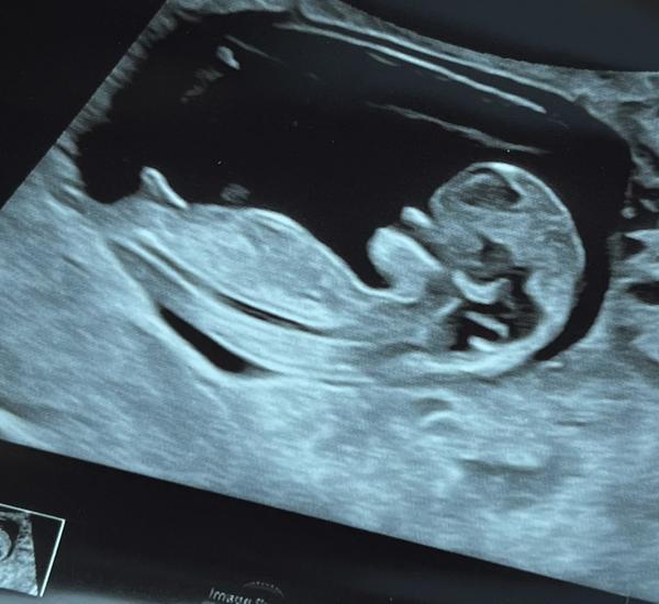 Dokážete odhadnout pohlaví miminka z ultrazvuku?