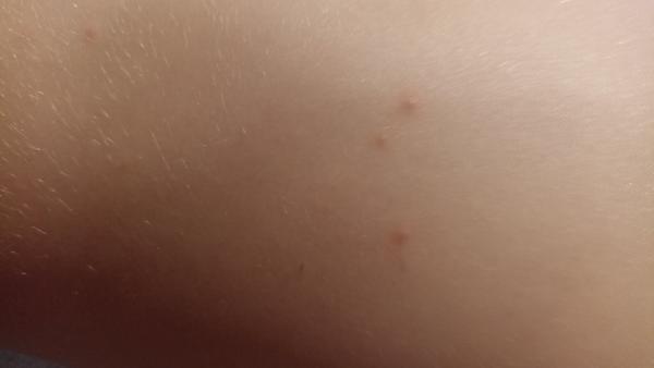 Rozpoznání vyrážky u dětí: Neštovice nebo štípnutí hmyzem?