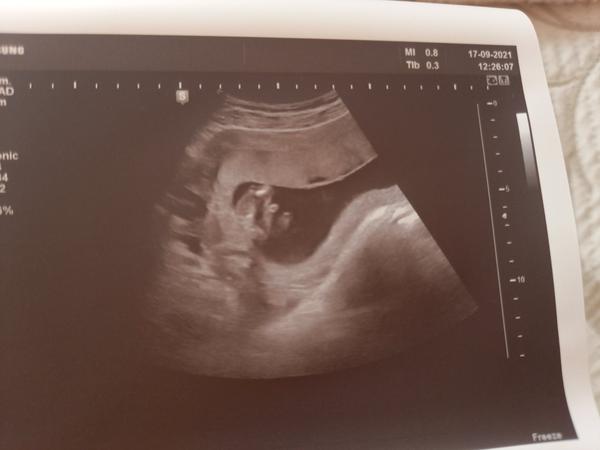 Ultrazvuk: Holka nebo kluk? Co si myslíte?