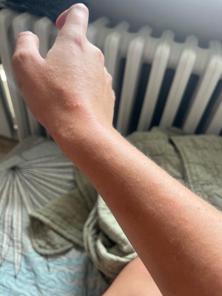 Jak rozeznat svrab od jiných kožních problémů?