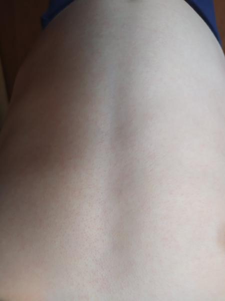 Vyrážka. Co by to mohlo být?