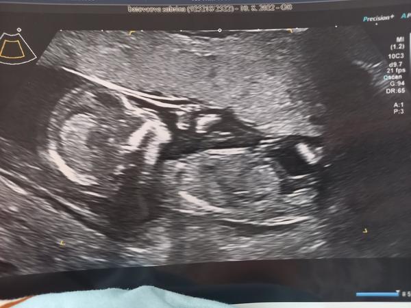 Vidíte pohlavní hrbolek na 1. screeningu?