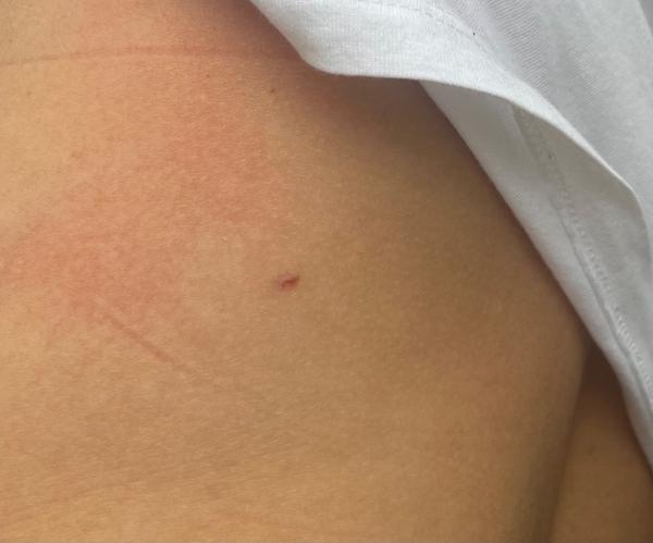 Mám se bát melanomu u drobného škrábance na zádech?