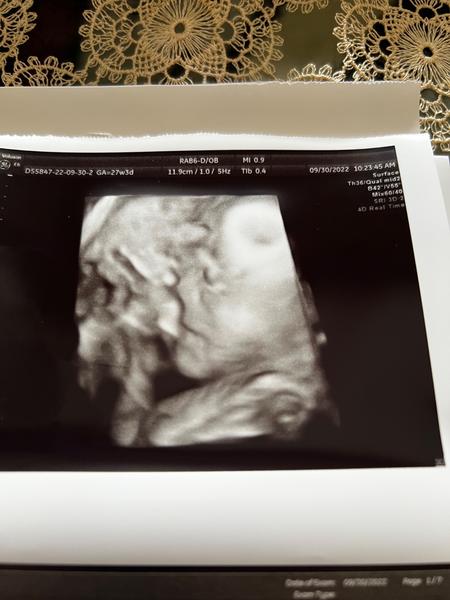 Odpovídá 4D ultrazvuk reálnému obrazu plodu?