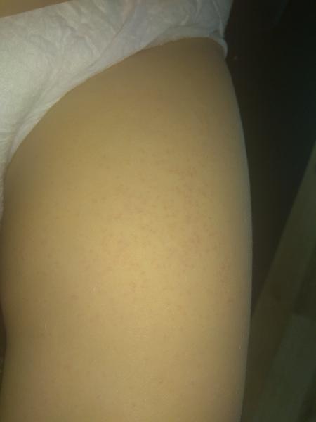 Vyrážka - krupička u dvouletého syna