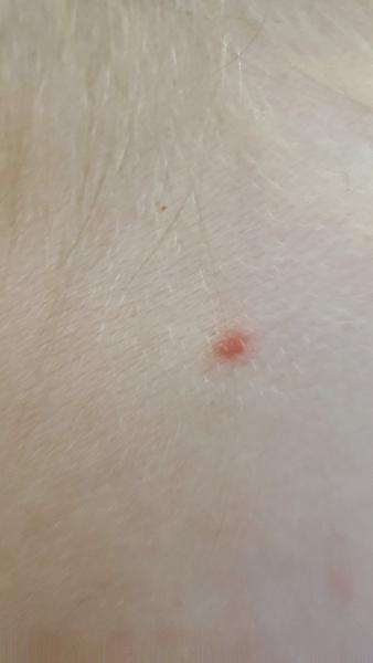 Červené pupínky. Může se jednat o alergickou reakci?