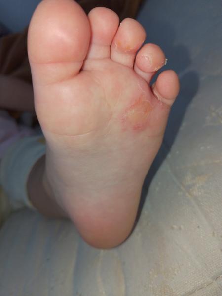 Vyrážky na noze dítěte. Co může být příčinou a jak léčit?
